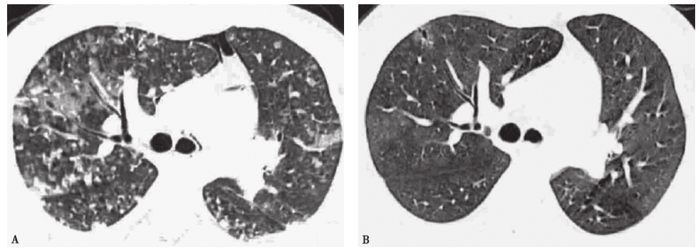 图7 急性过敏性肺炎胸部CT表现.jpg